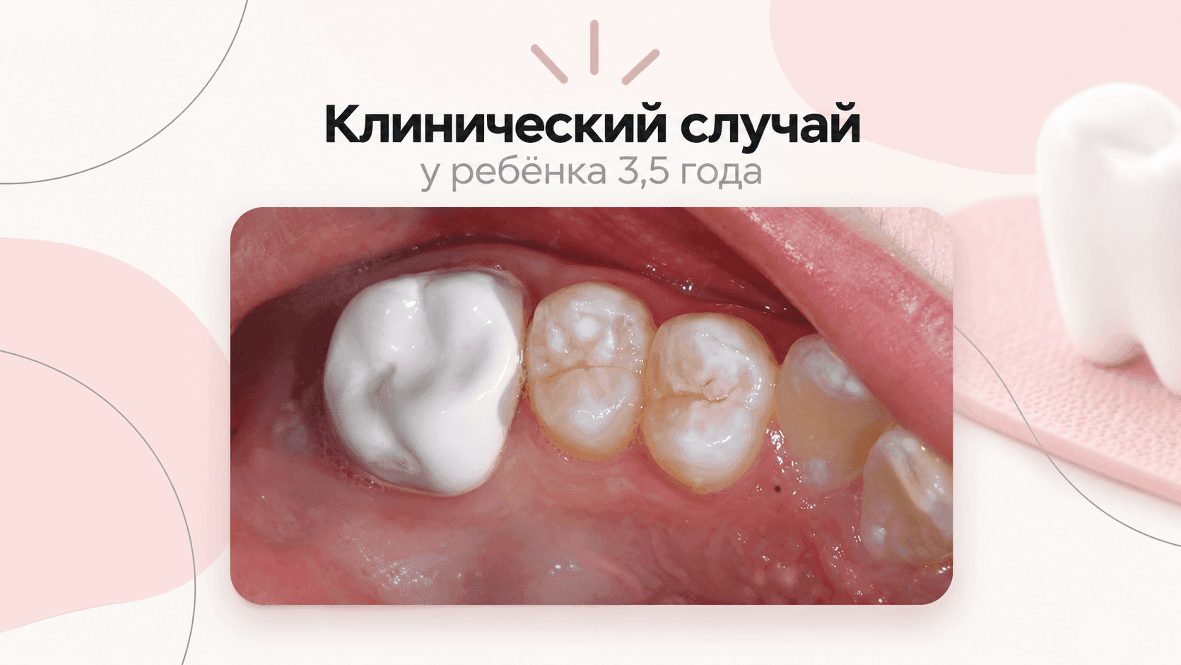 КЕЙС | КОРОНКА В 3,5 ГОДА